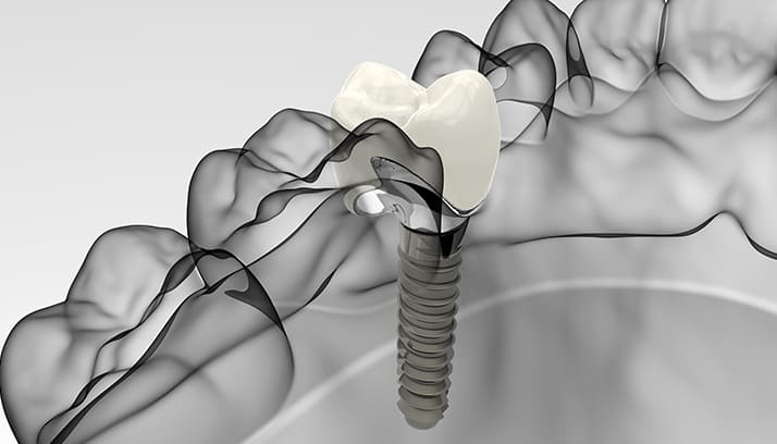 しっかり噛めない歯がないを治す治療